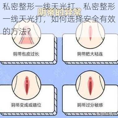 私密整形一线天光打、私密整形一线天光打，如何选择安全有效的方法？