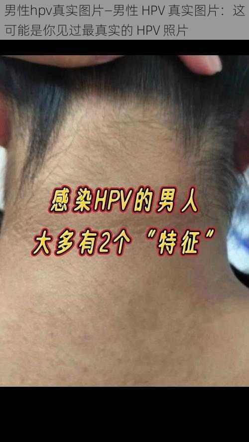 男性hpv真实图片—男性 HPV 真实图片：这可能是你见过最真实的 HPV 照片